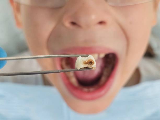 Best Emergency Tooth Extraction in Piedmont, AL